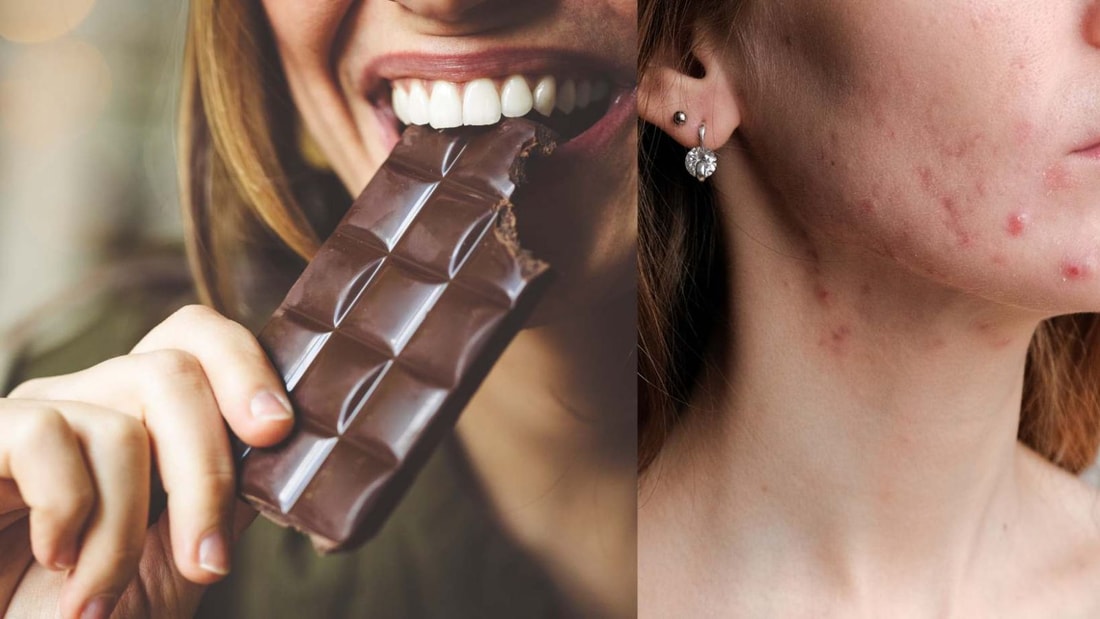 Acné : un carré de chocolat par jour, 10 boutons en plus sur le visage une semaine après