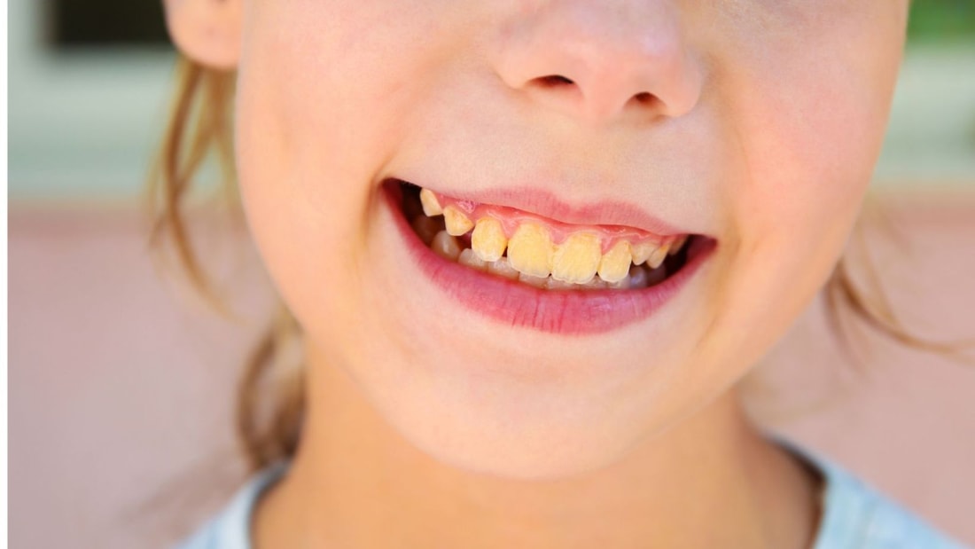 Cet aliment courant est pire que le sucre pour vos dents