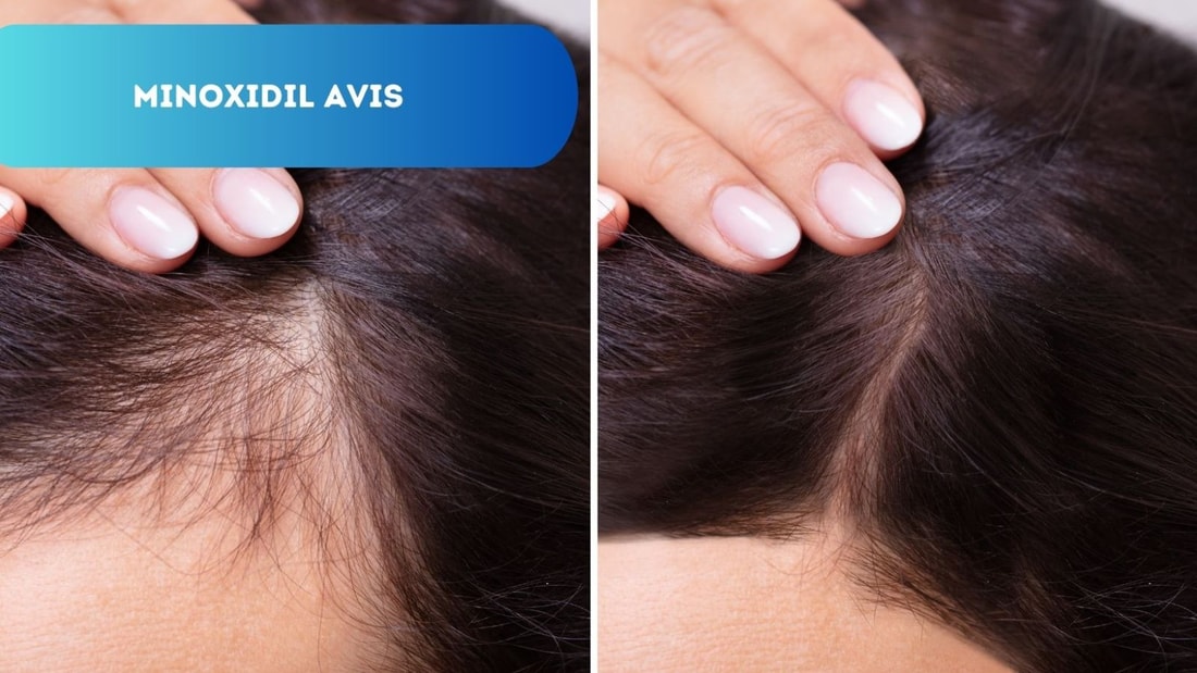 Avis Minoxidil: Solution Miracle ou Hype?