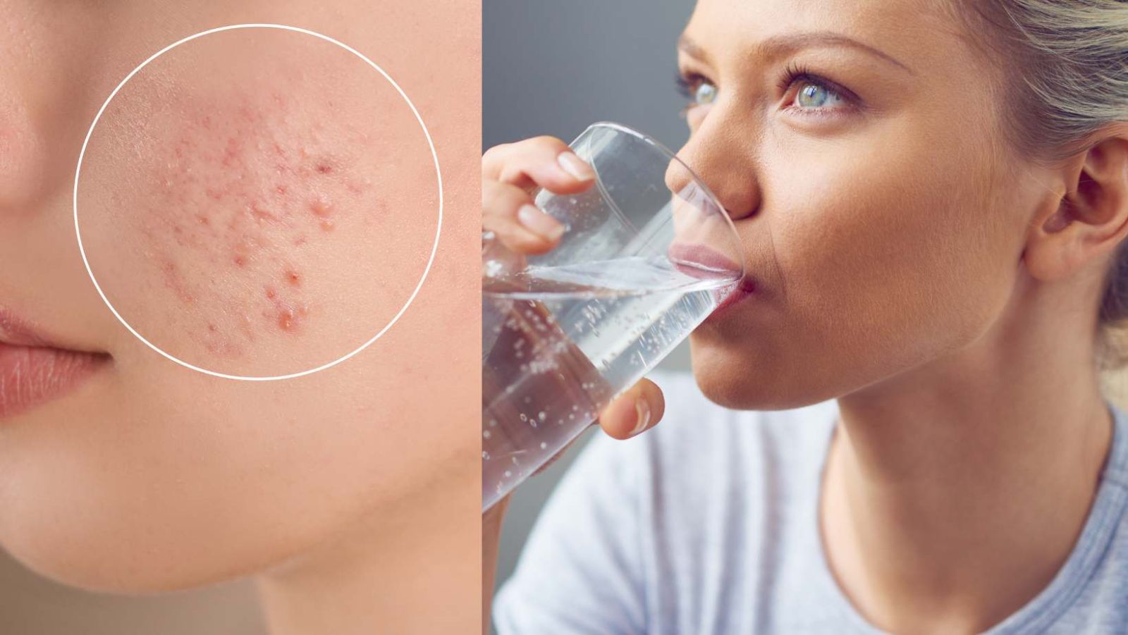 Le secret d'une peau sans acné : buvez cette quantité d'eau chaque jour
