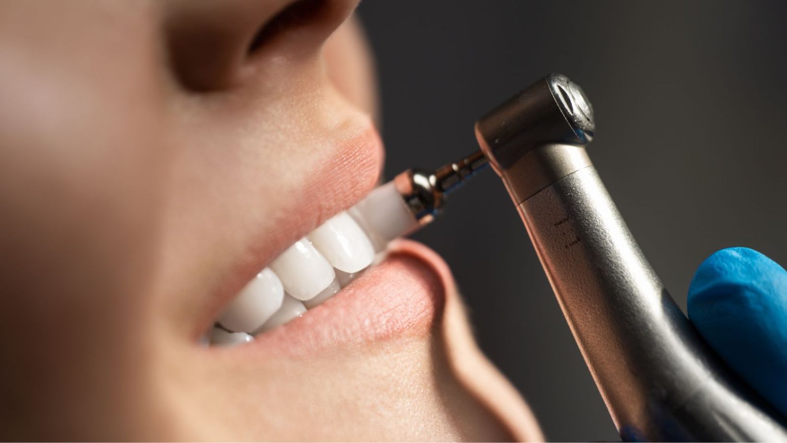 Plaque dentaire : pourquoi votre brosse à dents est impuissante face aux microbes